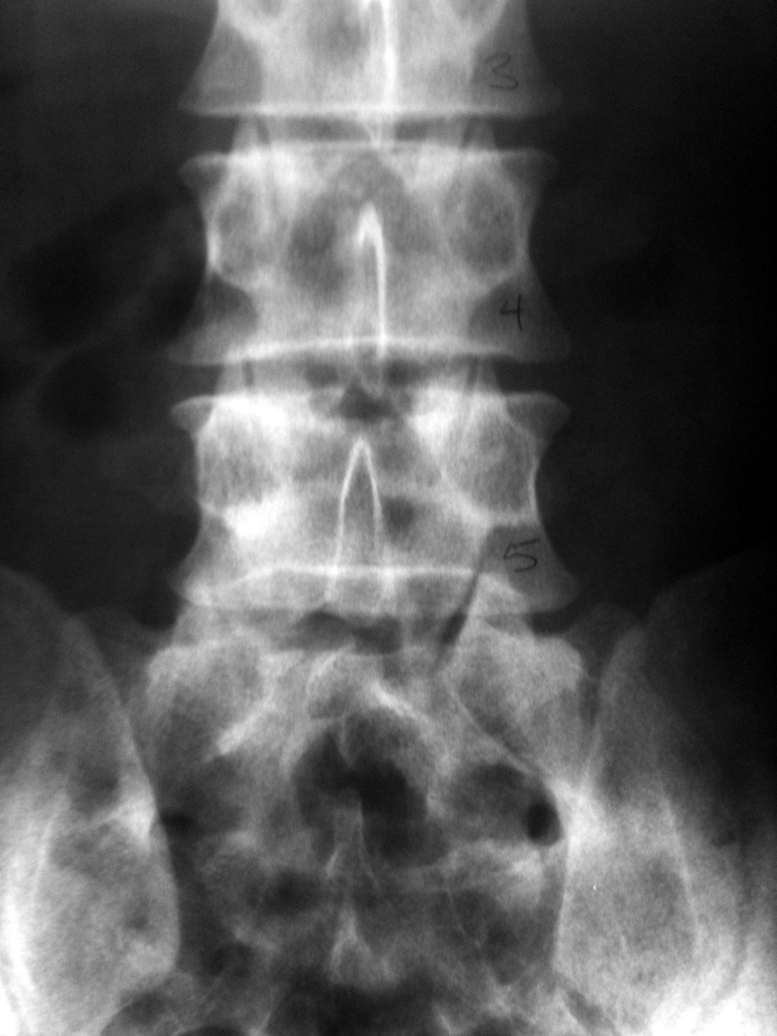 Ankylosing Spondylitis Car Accident Ankylosing Spondylitis Car Accident
