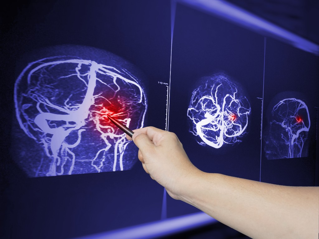 Defining Permanent Serious Impairment or Injuries in a Personal Injury Case