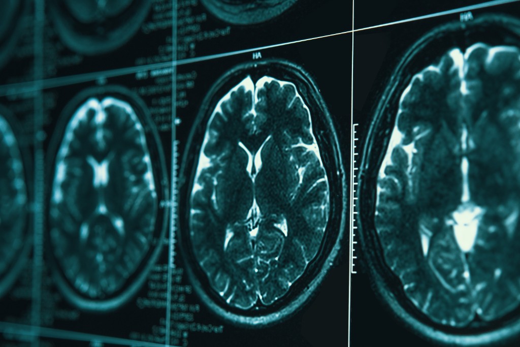 The Human Cost of Traumatic Brain Injuries